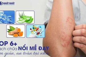 Top 6 cách chữa nổi mề đay đơn giản, an toàn tại nhà