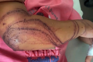 Bé gái 7 tuổi bị sứa đốt đến bất tỉnh khi tắm biển