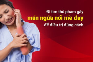 Đi tìm thủ phạm gây mẩn ngứa nổi mề đay để điều trị đúng cách