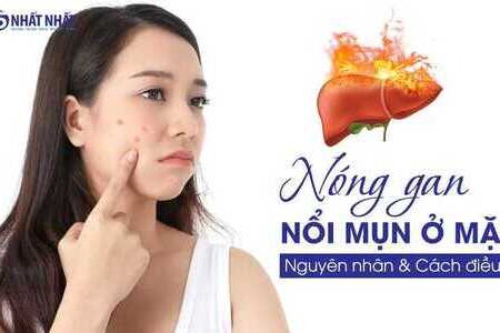 Nóng gan nổi mụn ở mặt: Nguyên nhân & cách điều trị