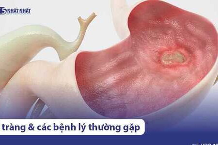 Tá tràng là gì? Nằm ở vị trí nào? 4 bệnh lý tá tràng thường gặp