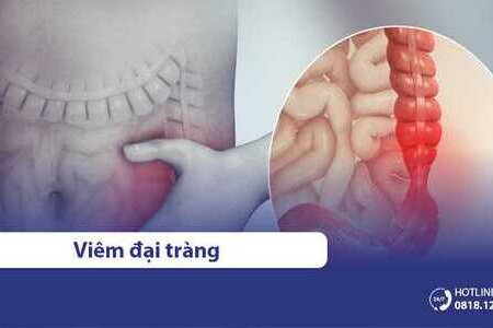 Viêm đại tràng: Nguyên nhân, dấu hiệu, triệu chứng & cách điều trị