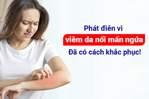 Phát điên vì viêm da nổi mẩn ngứa: Đã có cách khắc phục!