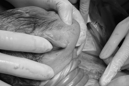 Mổ cấp cứu kịp thời cứu sống thai nhi bị dây rốn quấn 5 vòng quanh cổ