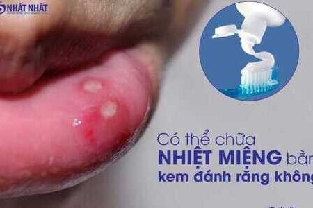 Có thể chữa nhiệt miệng bằng kem đánh răng được không?