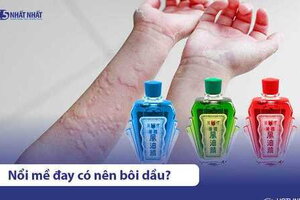 Nổi mề đay, dị ứng có nên bôi dầu? Top 5 loại tinh dầu nên dùng