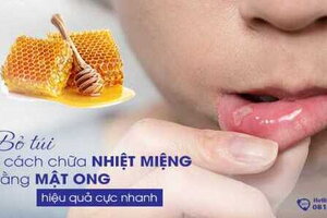 Bỏ túi ngay 3 cách chữa nhiệt miệng bằng mật ong đơn giản mà hiệu quả