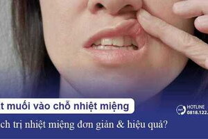 Trị nhiệt miệng bằng muối xát vào chỗ nhiệt miệng có hiệu quả?