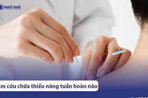 4 cách kết hợp châm cứu với bài thuốc Đông y chữa thiểu năng tuần hoàn não