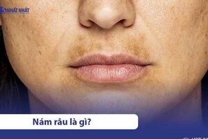 Nám râu là gì? 4 cách trị hiệu quả và nhanh chóng tại nhà