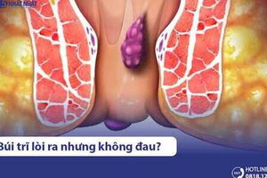 Búi trĩ lòi ra nhưng không đau có nguy hiểm không? Xử lý thế nào?