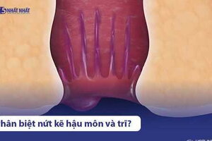 Nứt kẽ hậu môn và bệnh trĩ: Cách phân biệt & điều trị phù hợp