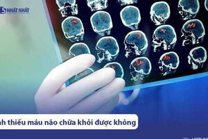 Bệnh thiếu máu não có chữa khỏi được không? Điều trị trong bao lâu?