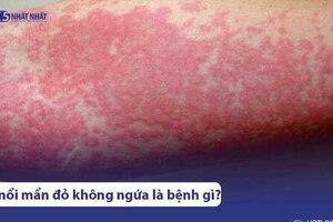 Da bị nổi mẩn đỏ không ngứa là bệnh gì? 4 cách chữa hiệu quả