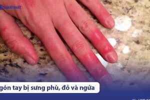 Ngón tay bị sưng phù, mẩn đỏ và ngứa là bệnh gì? Xử lý thế nào?
