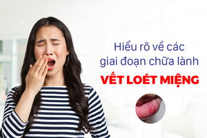 Hiểu rõ về các giai đoạn chữa lành vết loét miệng