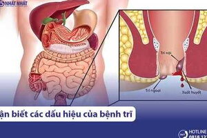 4 dấu hiệu giúp nhận biết bệnh trĩ nhanh chóng, chính xác