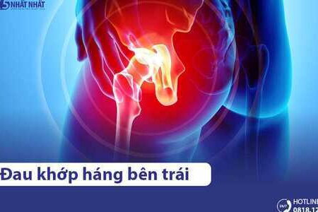 Đau khớp háng bên trái cảnh báo bệnh gì? Có nguy hiểm không?