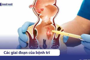 Tìm hiểu các giai đoạn của bệnh trĩ & cách điều trị phù hợp