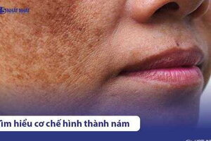 Nám chân sâu là gì? Nguyên nhân, biểu hiện và cách điều trị