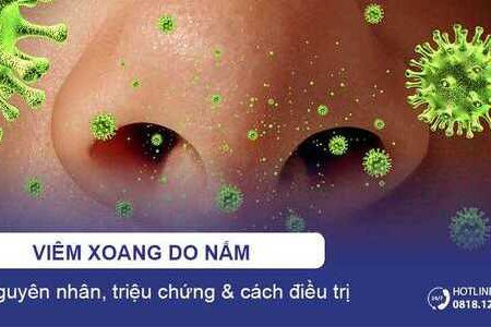 Viêm xoang do nấm: Nguyên nhân & cách điều trị