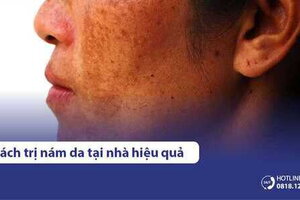 10 cách trị nám tại nhà hiệu quả bất ngờ bằng mẹo dân gian