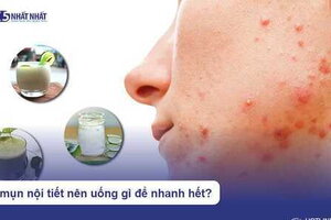 Bị mụn nội tiết nên uống gì để nhanh hết?