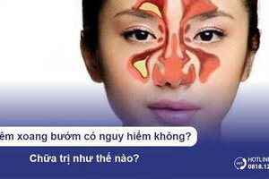 Viêm xoang bướm có nguy hiểm không? Chữa trị như thế nào?