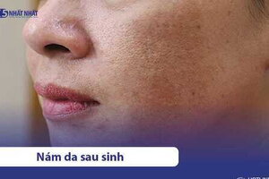 Nám da sau sinh: Nguyên nhân, Cách điều trị và Phòng ngừa