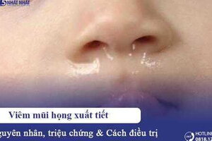 Viêm mũi họng xuất tiết: Nguyên nhân, triệu chứng & cách điều trị