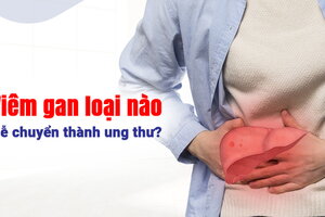 Tư vấn: Viêm gan loại nào dễ chuyển thành ung thư?