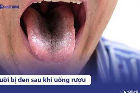 Vì sao lưỡi bị đen sau khi uống rượu? Có nguy hiểm không?