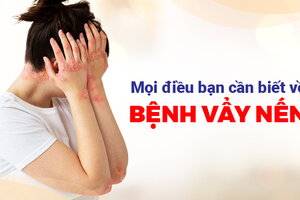 Mọi điều bạn cần biết về bệnh vẩy nến