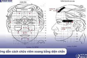 Hướng dẫn cách chữa viêm xoang bằng diện chẩn