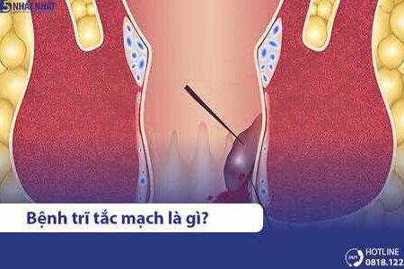 Trĩ tắc mạch có nguy hiểm không? Triệu chứng & cách điều trị