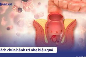 8 cách chữa bệnh trĩ nhẹ (mới hình thành) tại nhà hiệu quả nhất