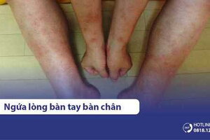 Ngứa lòng bàn tay, bàn chân là dấu hiệu bệnh gì? Cách trị ra sao?