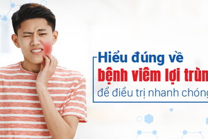 Hiểu đúng về bệnh viêm lợi trùm để điều trị nhanh chóng