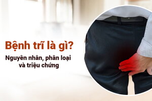 Giải đáp: Bệnh trĩ là gì, nguyên nhân, phân loại và triệu chứng