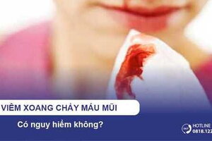 Viêm xoang chảy máu mũi có nguy hiểm không?