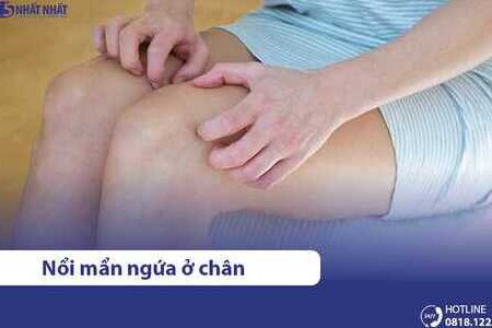 Nổi mẩn đỏ ngứa ở chân là bệnh gì? Nguyên nhân và cách điều trị