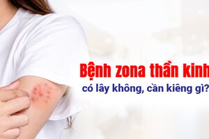 Bệnh zona thần kinh có lây không, cần kiêng gì?