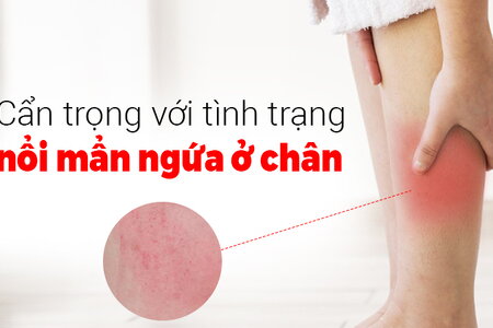 Cẩn trọng với tình trạng nổi mẩn ngứa ở chân