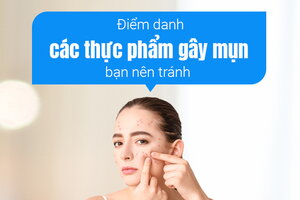 Điểm danh các thực phẩm gây mụn bạn nên tránh