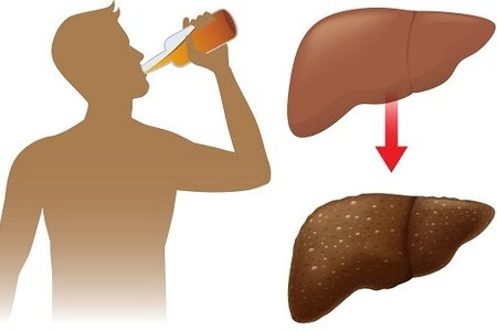 Cảnh báo những biến chứng nguy hiểm của viêm gan do rượu