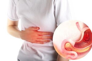 Loét dạ dày triệu chứng cảnh báo cần điều trị ngay!