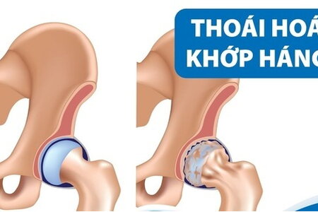 Bệnh thoái hóa khớp háng ở người trẻ: Những thông tin ít người biết