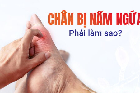 Giải đáp nhanh thắc mắc: Chân bị nấm ngứa phải làm sao?