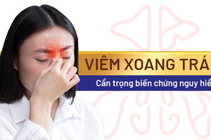 Viêm xoang trán: Cẩn trọng biến chứng nguy hiểm