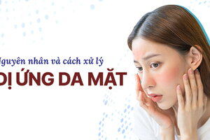 Nguyên nhân và cách xử lý dị ứng da mặt an toàn